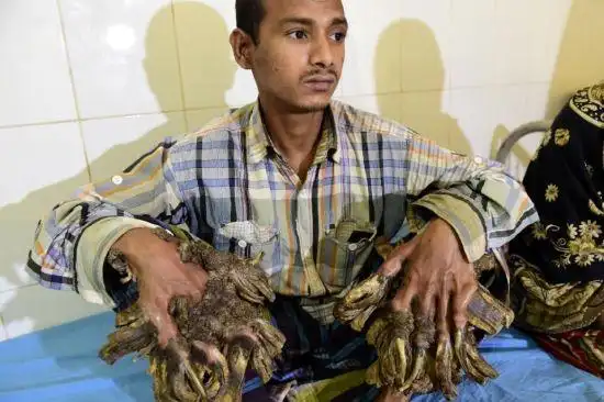 bangladeshs tree man undergoes successful surgery