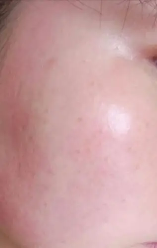 敏感皮肤红血丝激素皮炎用什么洗面奶水乳液比较好