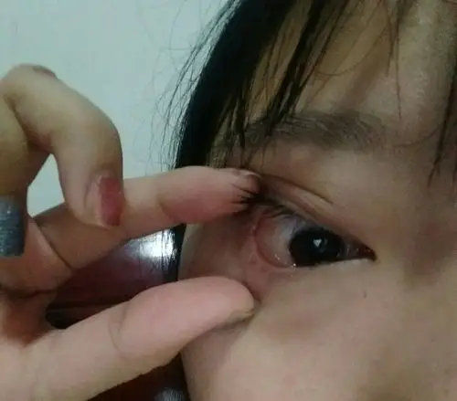 帮我看看我眼睛里这个白色大泡是什么 揉出来的