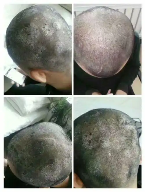 头癣患者治疗对比图
