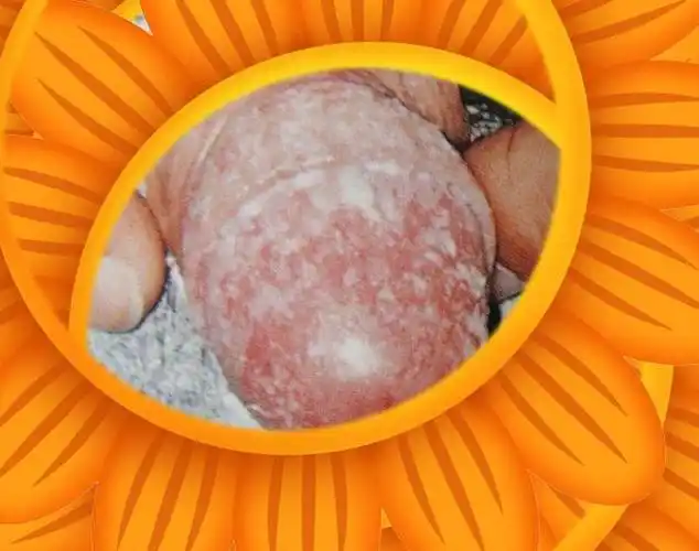 表现为龟头,包皮内侧弥漫性潮红或红色丘疹,伴鳞屑或乳白色斑片附着.