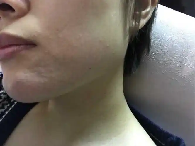 吃芒果过敏的人闻芒果会过敏吗?