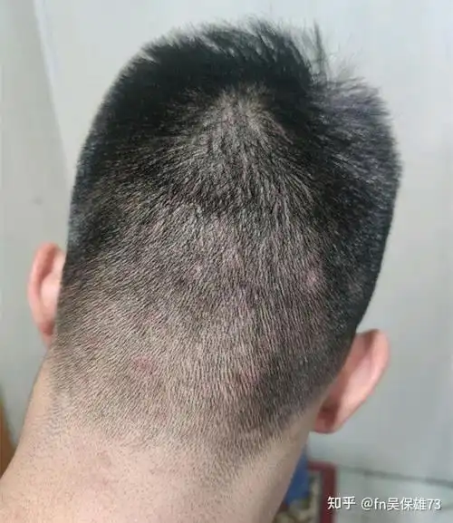 有什么可以彻底根治头皮毛囊炎的方法