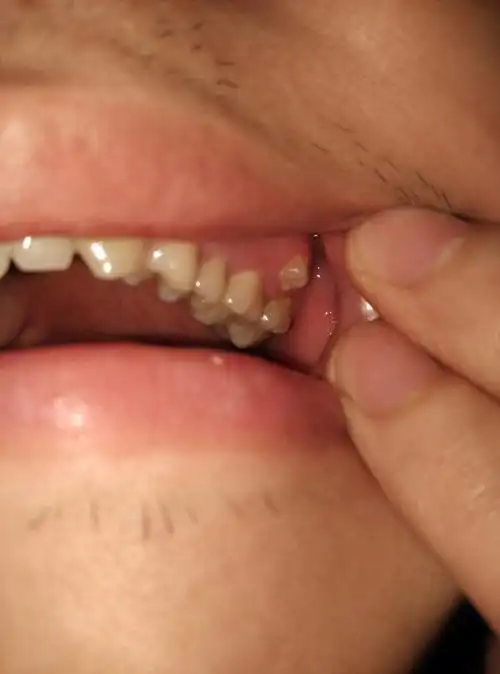 29岁了牙龈侧面长牙齿是怎么回事?