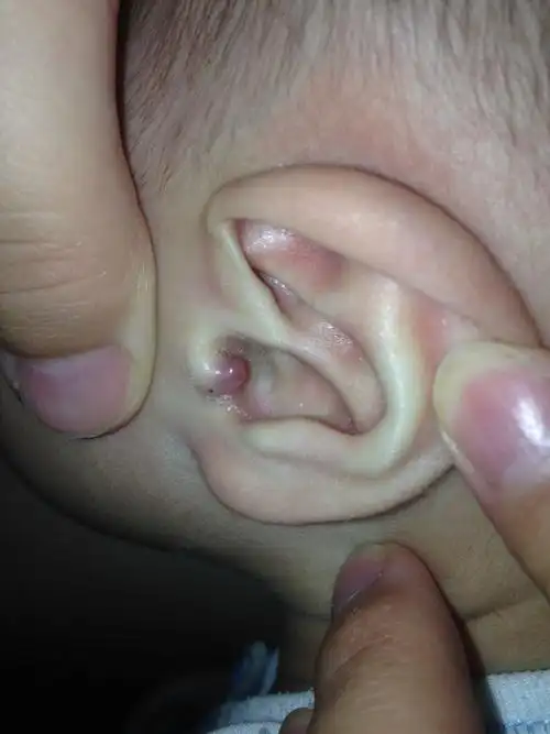 小孩耳朵长一个血红色的水泡,急