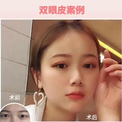 99697115虽然数不清的单眼皮女孩通过双眼皮手术重获新_圈子