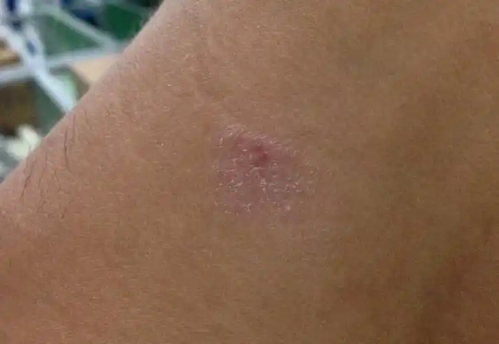 问:脖子上长了一块癣,不痛不痒,外面一层粉屑,如图片,这是什么情况?