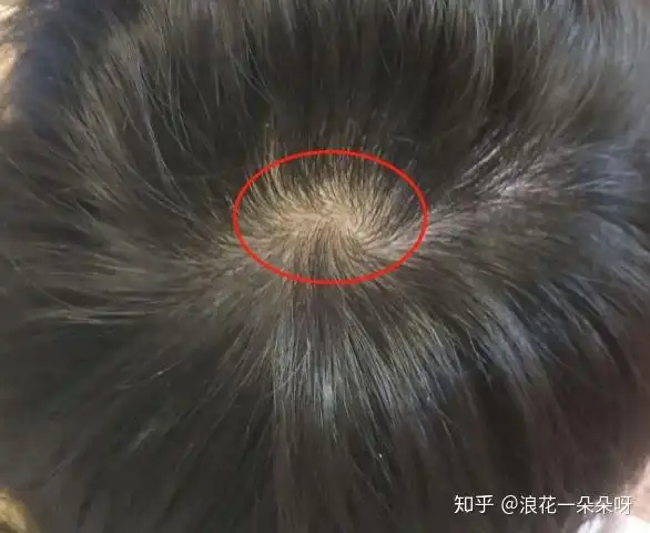 去拍了放大版的发囊,发现发囊里很多头发细的可怜