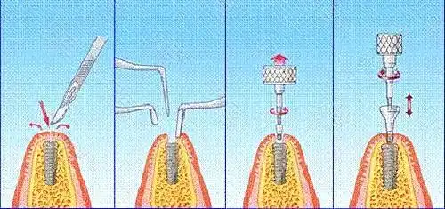 种植牙过程图