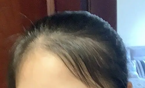 两鬓秃成这样了应该怎么拯救(慎