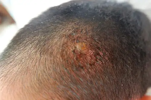 后脑勺长了个脓包,三四天了,挤了二次,现在好疼呀 有什么办法弄好吗