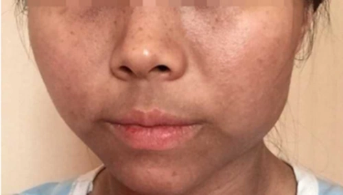 但如果肺不好,肺功能下降,气血正常运输受阻,那么脸就会显得黑沉沉的