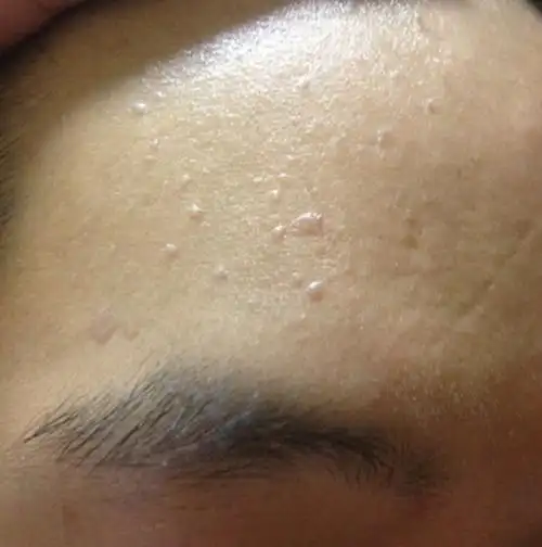 右脸的皮肤丝状疣的图片