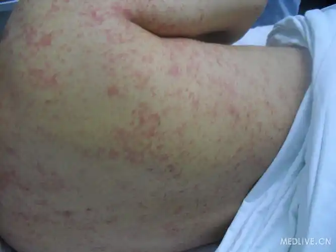肝硬化失代偿并发皮肤弥漫性斑丘疹
