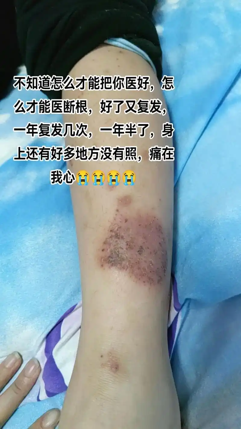 广大的抖音朋友,这个照片是我儿子身上长的癣,不知道怎么回事, - 抖音