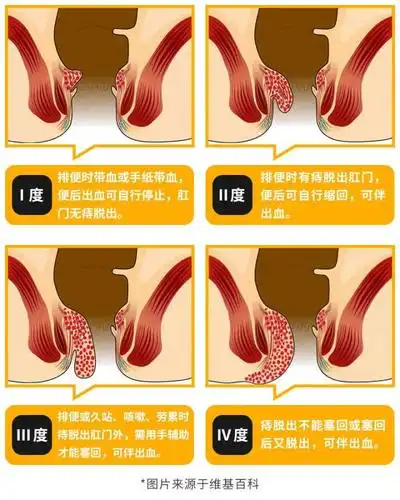 有痔疮是一种什么样的体验