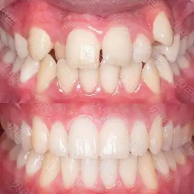 牙齿矫正前后