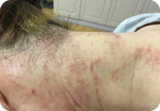 湿疹图片初期症状图片湿疹什么样算好了看完图片后就知道了