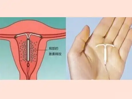 曼月乐是个什么环?_避孕_避孕治疗介绍 - 好大夫在线