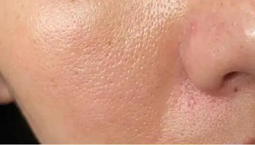 教你轻松缩小毛孔|保湿|去角质|收缩毛孔|敏感肌肤_网易订阅