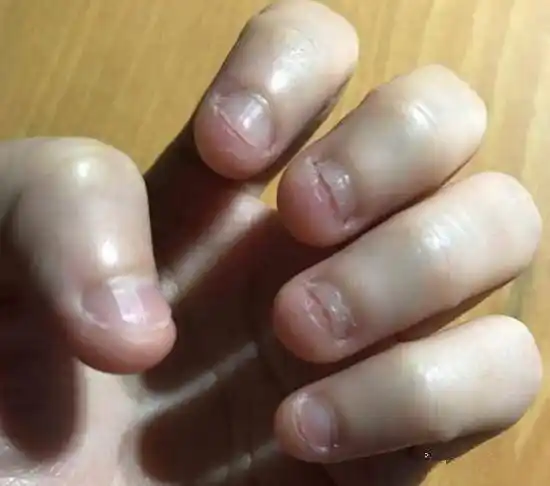 孩子爱"啃指甲"是缺微量元素?心理学家:别闹了,是心理问题