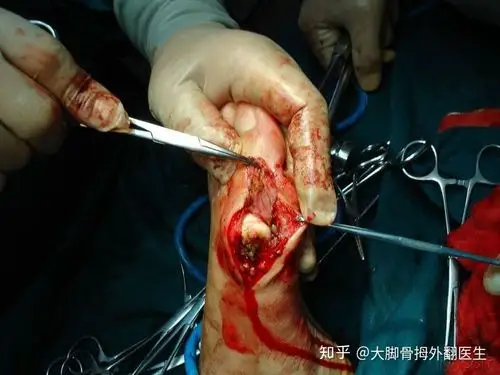 也是简单的截骨断筋,暂时看起来大脚骨的形状是治好了,但是没有办法