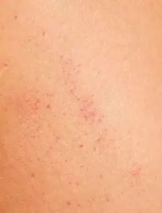 不健康的人皮肤质地覆盖红点刺激照片