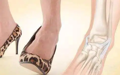 高跟鞋是崴脚利器?听听专家王继宏怎么说