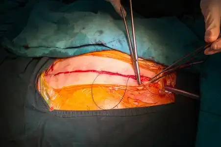 正中缝合关闭胸骨正中切口照片