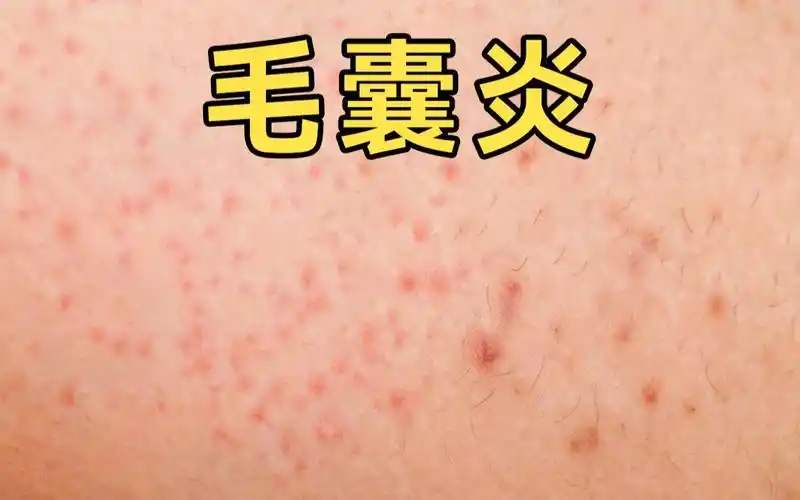 活动作品冷少密密麻麻的毛囊炎应该怎么治