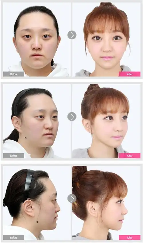 韩国整形真人秀,双鄂手术改变人生说的就是她!