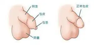 包茎及包皮过长