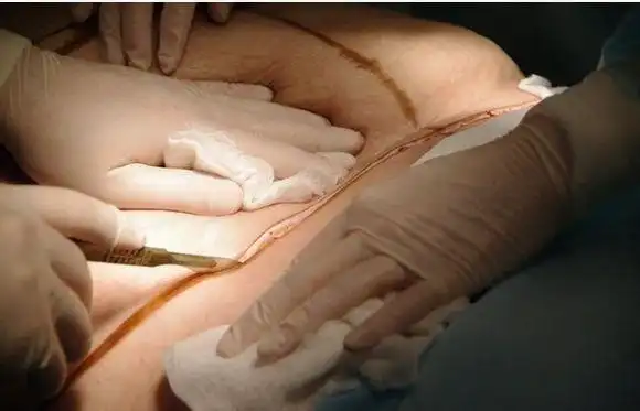 让你惊到的整形手术,全过程解析 (有图慎入)