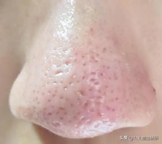 鼻子容易出油怎么改善(但是鼻子上那么爱出油呢)_可可情感网