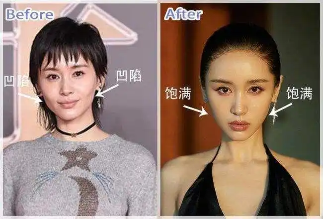 跟王子文学习面部填充大变活人实现逆龄神话