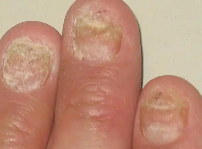 银屑病甲_治疗_原因_症状_检查_银屑病甲并发症_第5页_大成皮肤网