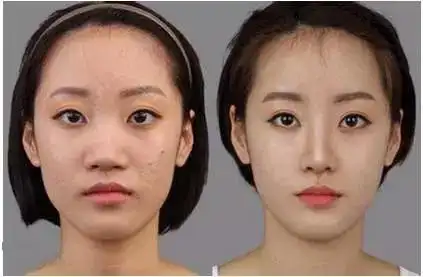 微整形逆天改运的秘密--美莱玻尿酸注射塑形