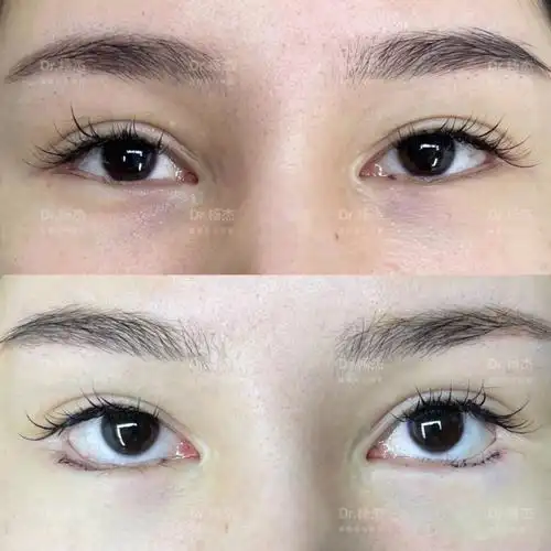 外眼角下至#眼睑下至