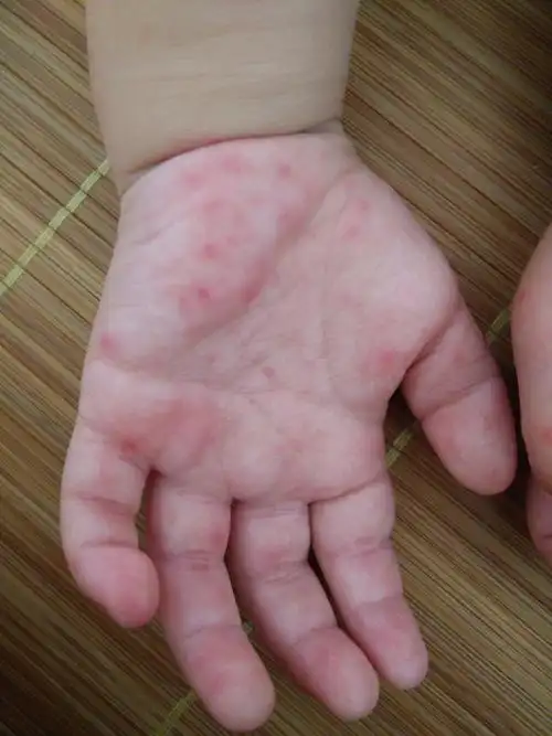 宝宝得了手足口病