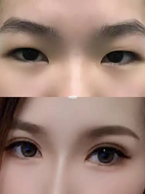 全切双眼皮对比照