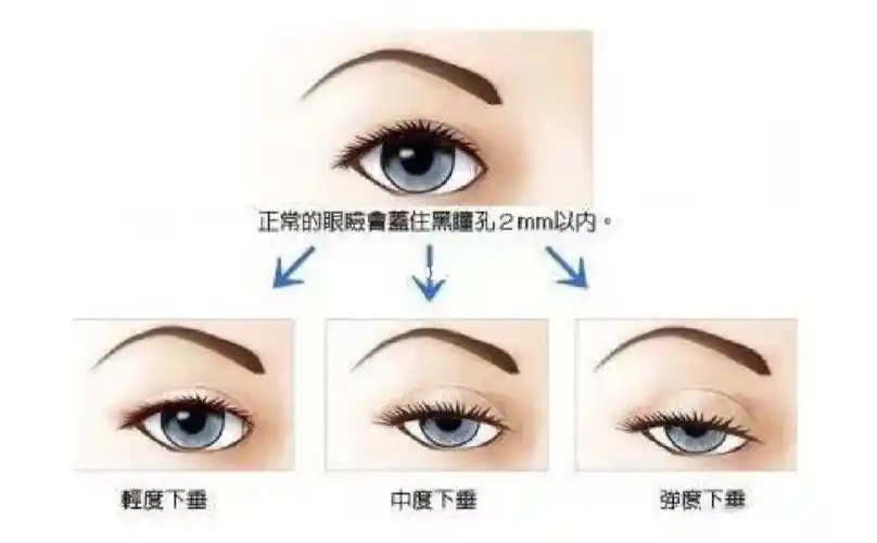 深圳剥离眼睑下垂严重记得提肌啊