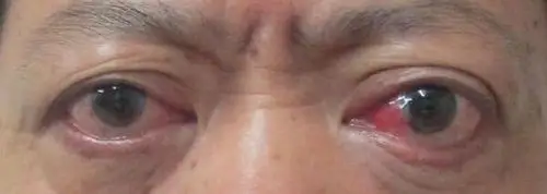 > 下睑退缩--手术治疗前后对比图