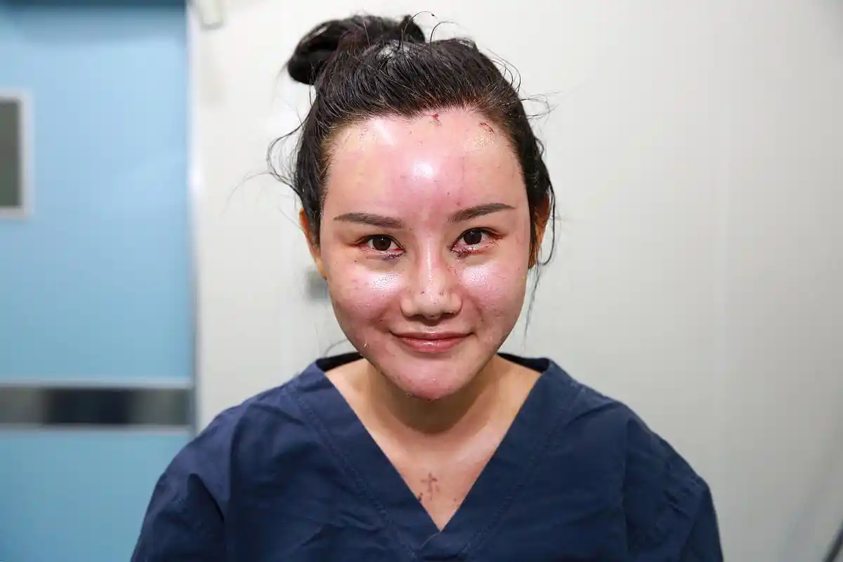 面部脂肪填充部位安全吗	 面部脂肪填充是以自体脂肪作为填充凹陷面部