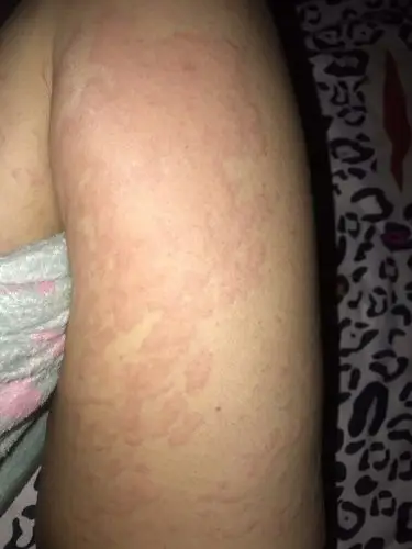 这是过敏性荨麻疹吗?