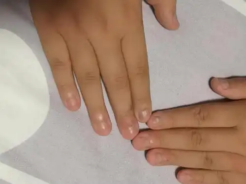 儿童咬指甲十年 - 儿科专业讨论版 -丁香园论坛