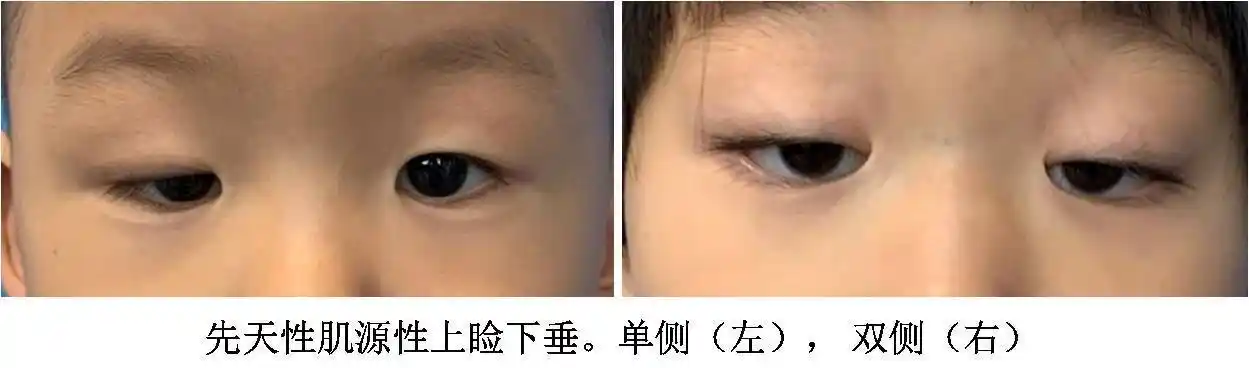 (1)肌源性:肌源性上睑下垂可以是先天性的,也可以是后天性的.