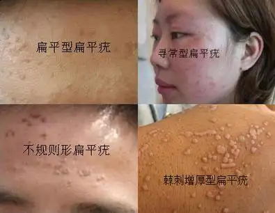 从图片上识别扁平疣的3大症状