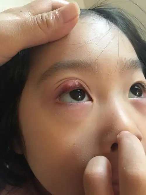 霰粒肿全麻手术值得不值得?