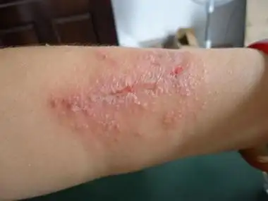 疱疹样皮炎胳膊一片小水疱图