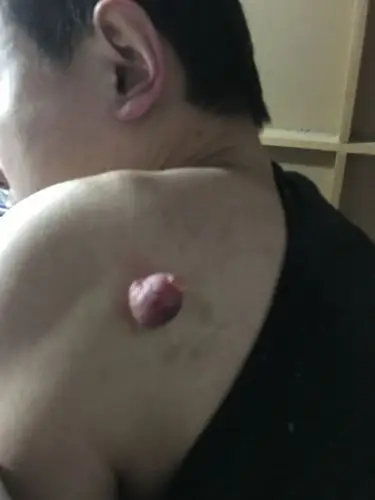肩膀上长了个肉球是什么,还有点疼